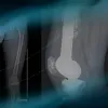 Metaphyseal break of a custom-made massive knee prosthesis 