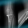 Management of a knee instability after ski trauma in a young woman​