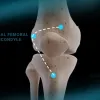 Chistera approach to total knee arthroplasty