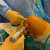 Revision PCL reconstruction