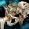 Management of a sequela of an acetabular fracture