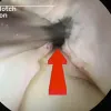 Anatomical inside-out remnant preserving anterior cruciate ligament recontsruction: an optimal surgical technique for biological ACL reconstruction