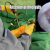All-Arthroscopic anterior and posterior arthrolysis for extension deficit after ACL reconstruction