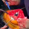 Onlay patellofemoral arthroplasty - Hermes, it couldn't be simpler