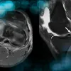 Ramp Lesion