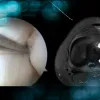 Radial tear