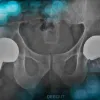 Management of a severe bone loss in a patient with hip resurfacing