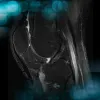 Management of a chronic multiligament knee injury