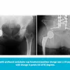 Excellence in hip research award: Pelvic tilt and cup position change significantly in most young patients 10 years after hip arthroplasty