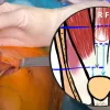 Harvesting Rectus Femoris for ACL reconstruction: a step by step approach