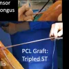 Minimally invasive approach to multi-ligament knee reconstruction: arthroscopic PCL and PLC with percutaneous LCL reconstruction