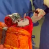 Revision Total Knee Arthroplasty using the EnduRo® Hinged prosthesis (B.Braun): surgical technique