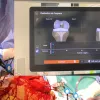Revision of unicompartmental knee arthroplasty to total knee arthroplasty using a robotic system : a smart, efficient and conservative approach