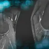 Re-revision ACL reconstruction plus meniscal transpalantation in a young patient