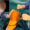 Flip-then-fill: Adjustable-loop pre-lengthening to facilitate button flipping before gaft passage in ACL reconstruction with femoral suspensory fixation