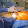 Knee Joint preservation in Japan: TCVO, inpatient rehab & surgical mastery 
