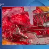 Femoral stem extraction without osteotomy: Step-by-step sugical technique