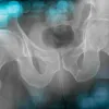 Management of a coxarthrosis secondary to a complex acetabular fracture