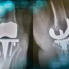 Clinical Challenge: How would you address this complex revision TKA case?