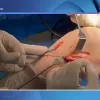 ACL reconstruction with lateral extra-articular tenodesis (LET): understanding the modified Ellison procedure