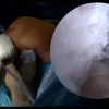 BTB Autograft ACL Reconstruction: why technique matters | Virtual fellowship with Jorge Chahla