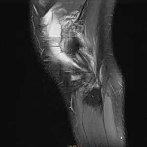 Management of an ACL graft failure in a high-level pivoting sport athlete