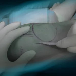 Mini-open approach to the articular surface of the patella