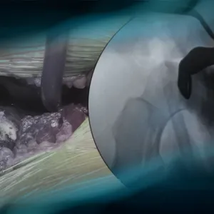 Hip dysplasia in a young woman: How should I treat?