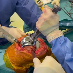 Uncemented total knee arthroplasty