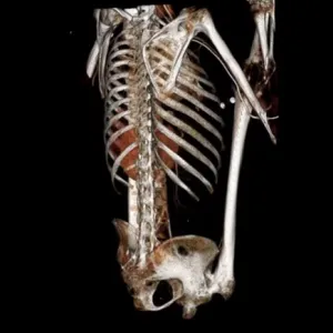 Bilateral girdlestone procedure