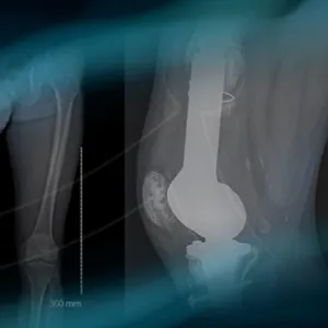 Metaphyseal break of a custom-made massive knee prosthesis 