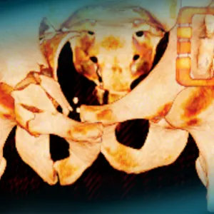 Management of a complex pelvic fracture in a 43-year-old man