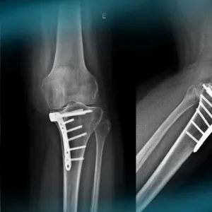 Management of a knee instability after ski trauma in a young woman​