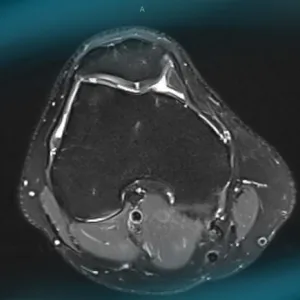Management of chondral ‘kissing’ lesion of patella and trochlea