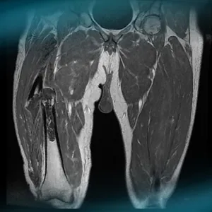 Dedifferentiated chondrosarcoma
