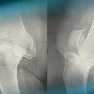 Management of complex knee arthritis with ligament deficiency