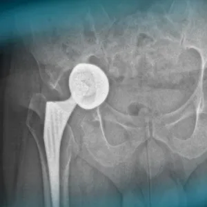 Management of an acetabular cup loosening with severe bone loss