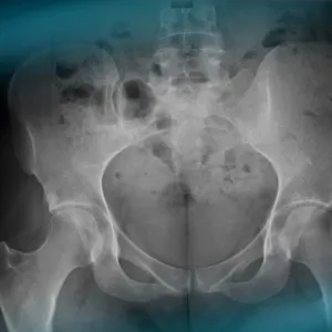 Management of hip pain in a 30-year-old woman