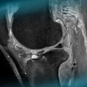 Management of an ACL reconstruction in a professional disabled sport with transtibial amputation​