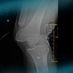 Management of a multiligament knee injury in a high-level pivoting sport athlete