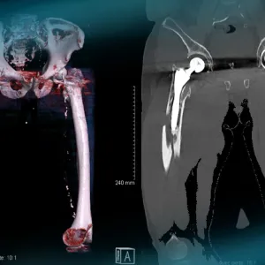 Management of a peri prostetic femoral fracture