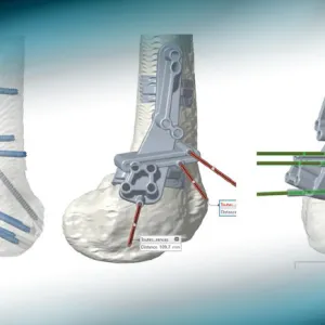 Management of an inveterate dislocation of the patella