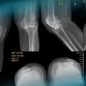 Management of a patellar tendon avulsion after TKA