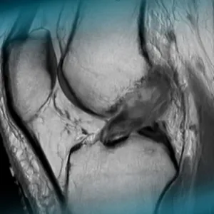 Acute ACL tear in a professional rower