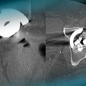 Management of a hip pain in a 51 year-old man with THA