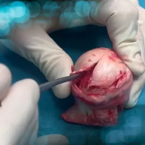 Femoral head avascular necrosis