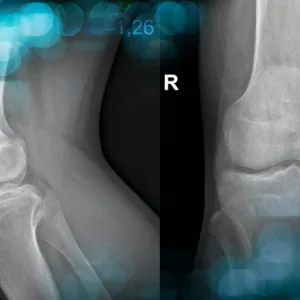 Management of a postoperative persistent patellofemoral instability in a young athlete