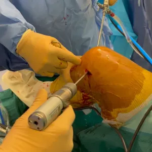 Revision PCL reconstruction