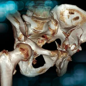 Management of a sequela of an acetabular fracture