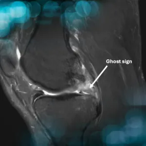 Medial meniscus root tear 